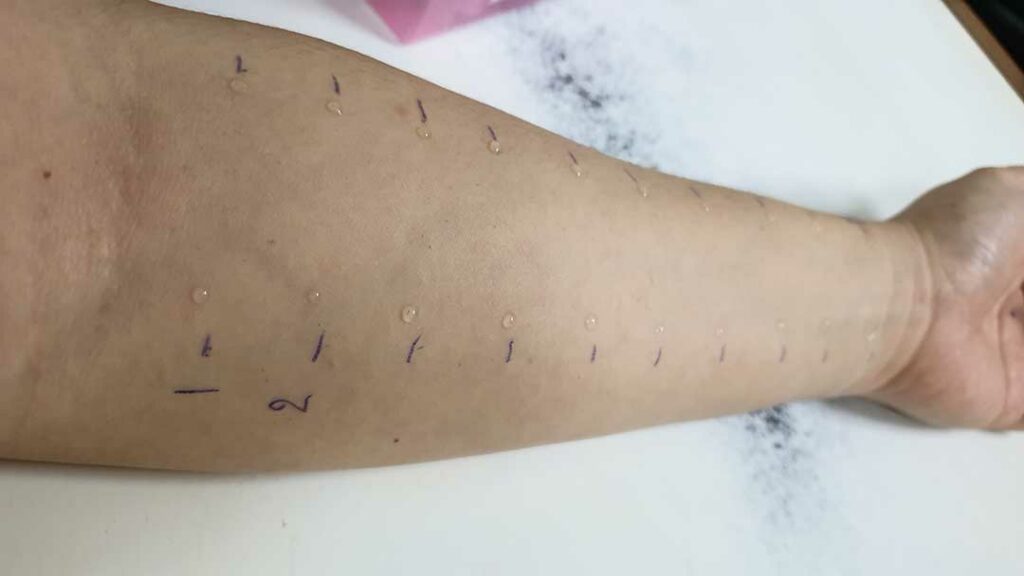 Pruebas de alergia