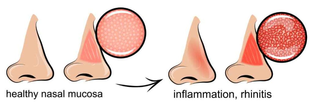 Comparación de la rinitis con una vía nasal sana
