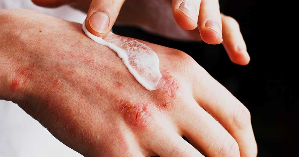Primer plano de manos con eczema y un dedo untando loción.