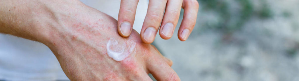 Foto de las manos de un hombre. Se está poniendo crema con esteroides para tratar el eczema en el dorso de la mano.