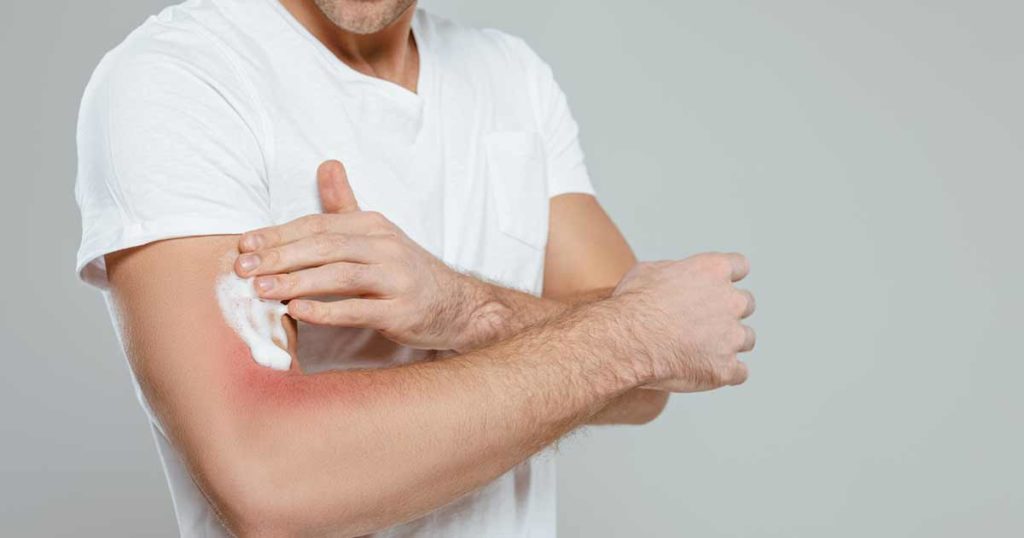 Hombre poniéndose crema para el eczema en el brazo