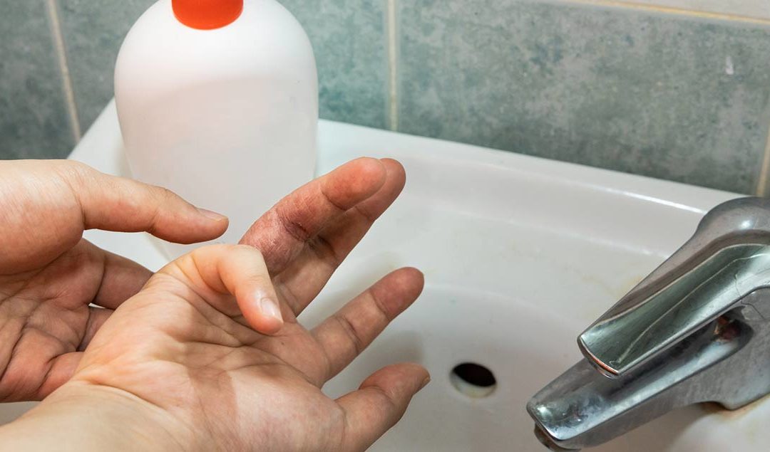 El eczema y el lavado de manos con frecuencia