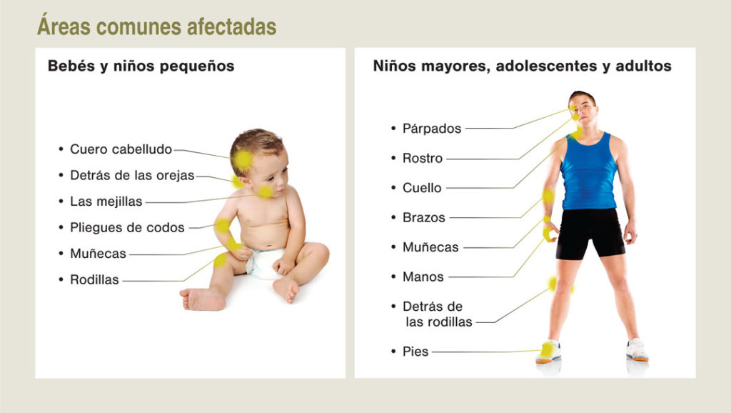 Gráfico que muestra las áreas comunes afectadas por el eczema