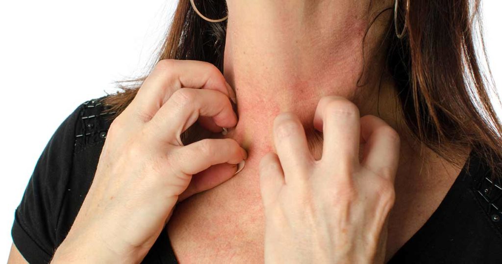 Mujer rascándose el cuello a causa de un eczema moderado