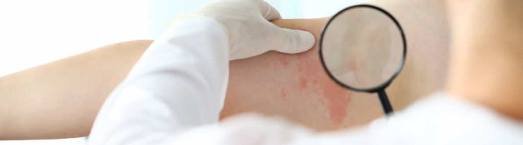 Médico con guantes blancos de seguridad que sostiene una lupa. Examina a la paciente para saber qué tipo de eczema tiene.
