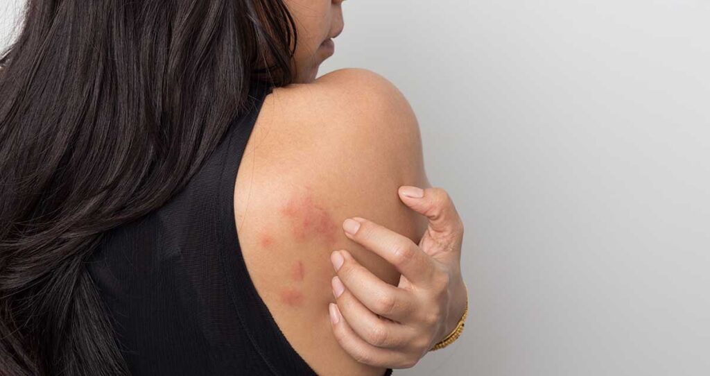 Se muestra de perfil a una persona con cabello largo y oscuro, que lleva una camiseta negra sin mangas. Se está rascando una zona de piel roja e irritada en la parte superior del brazo.