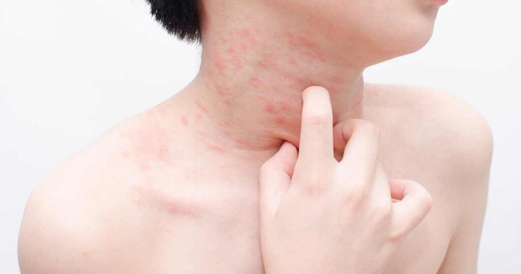Niño con urticaria crónica rascándose el cuello.