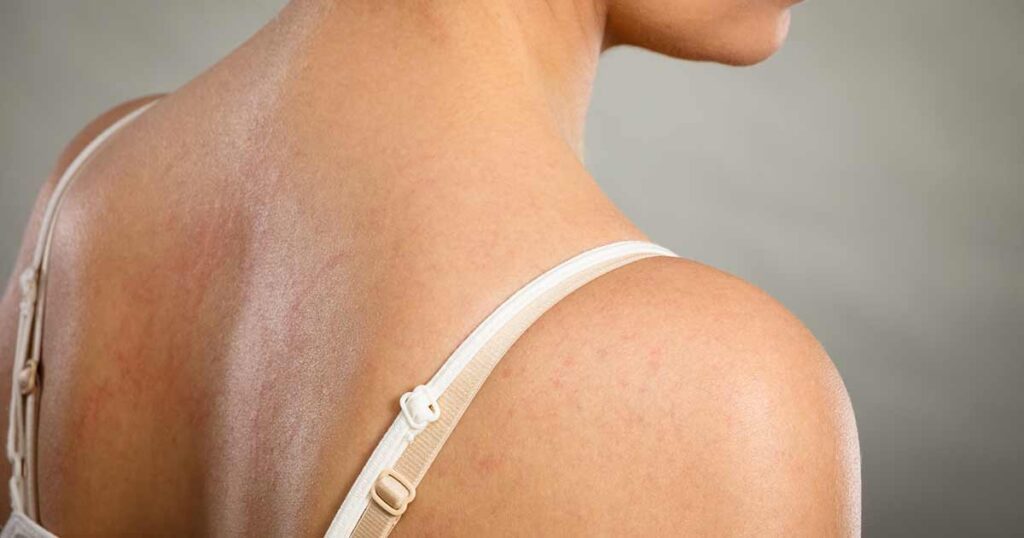La espalda de una mujer cubierta en ronchas.