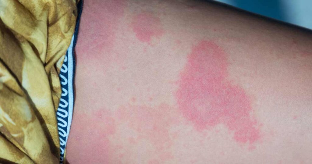 Urticaria en la pierna de una mujer.