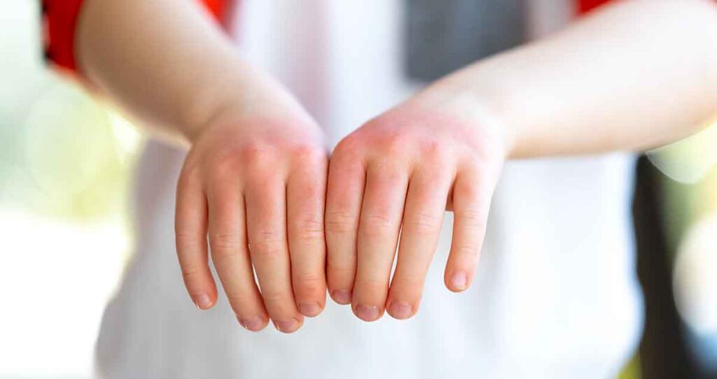 eczema severo en la mano de los niños pequeños