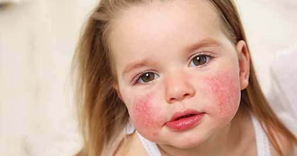 erupción cutánea por alergia alimentaria