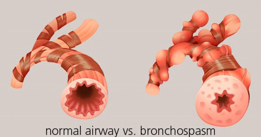 Ilustración que muestra una vía respiratoria normal con conductos lisos y abiertos a la izquierda en comparación con un broncoespasmo a la derecha, que muestra vías respiratorias estrechas con músculos constreñidos y tejido inflamado.