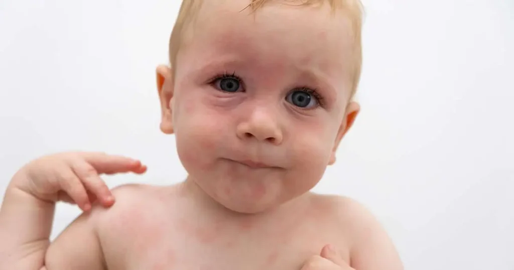 Un bebé de piel clara y ojos azules, posiblemente mostrando signos de anafilaxia infantil, tiene un sarpullido en la cara, el pecho y los brazos, y mira directamente a la cámara con una expresión neutra sobre un fondo blanco liso.