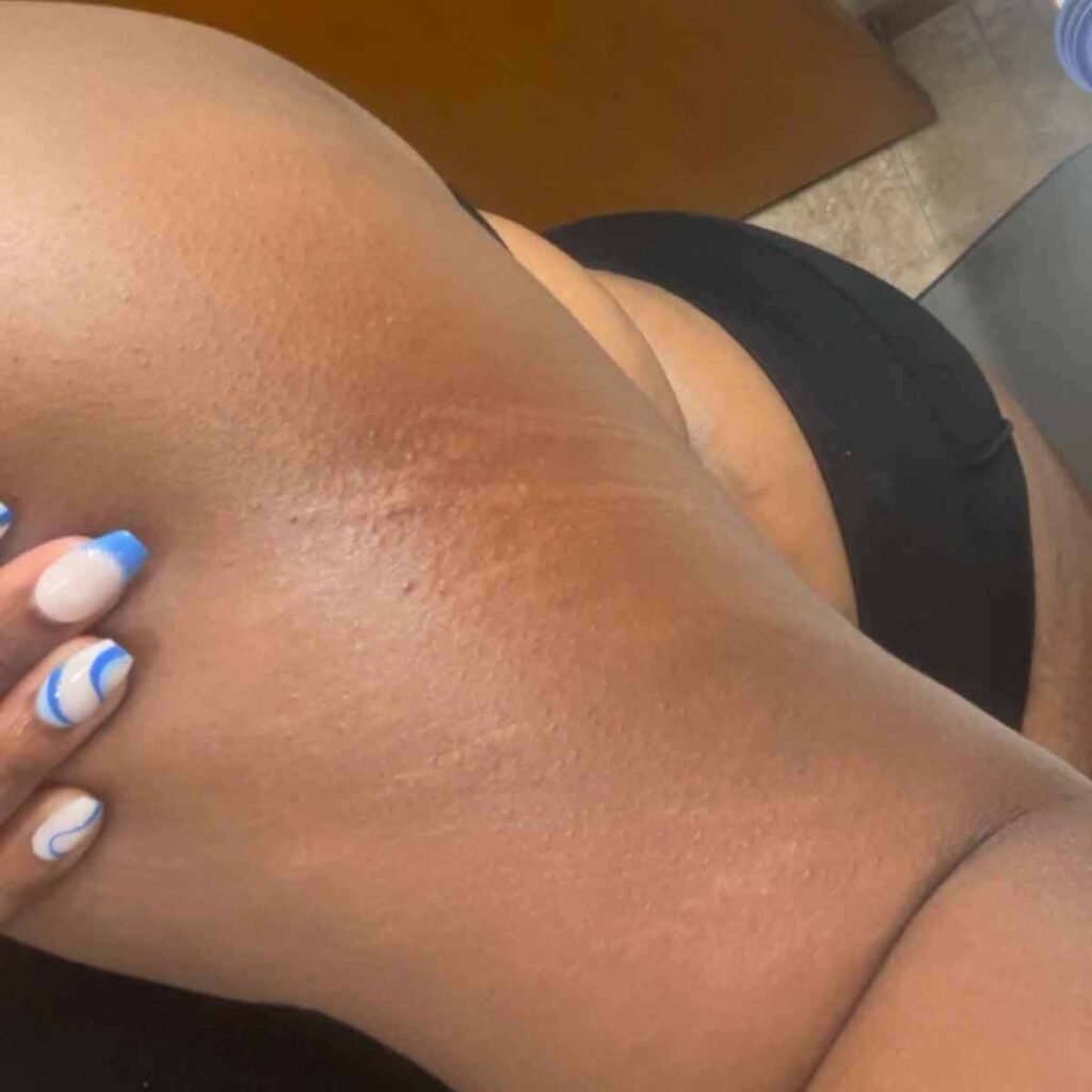 Primer plano de la axila de una persona que muestra cierta decoloración y textura en la piel. La persona tiene las uñas manicuradas con diseños azules y blancos y viste ropa negra.