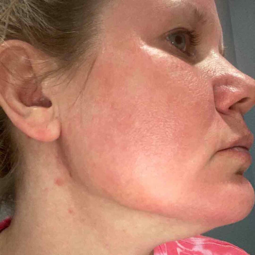 Primer plano lateral del rostro de una mujer de piel clara, que muestra enrojecimiento e irritación leve en la mejilla y la mandíbula. Lleva una blusa rosa y mira ligeramente hacia arriba.