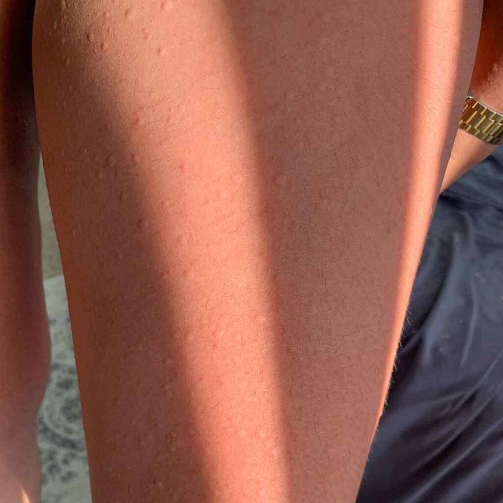 Primer plano del brazo quemado por el sol de una persona, donde se aprecia la piel de gallina. La persona lleva un reloj de oro y ropa oscura.