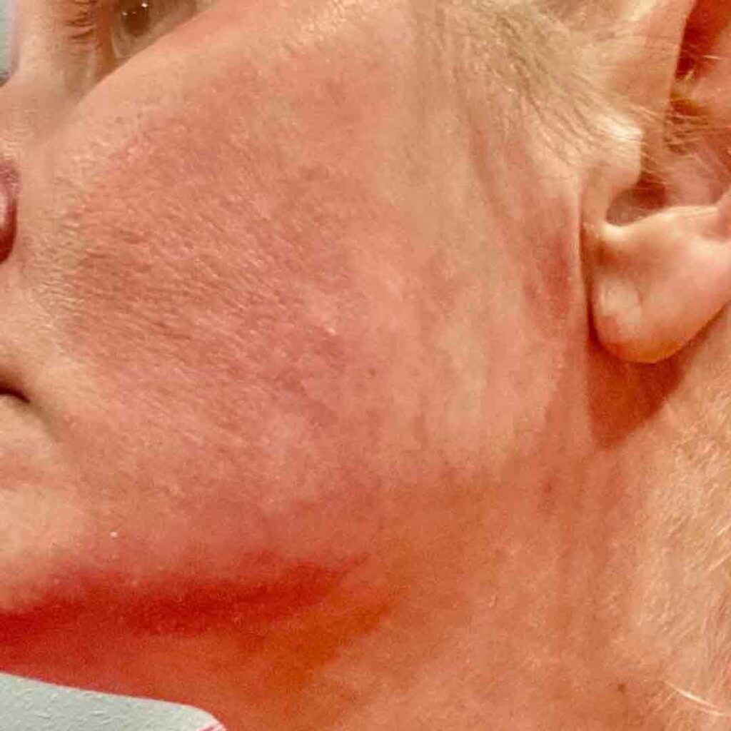 Primer plano de la parte inferior del rostro, mejilla, mandíbula y oreja de una persona de piel clara, que muestra la textura de la piel y los poros, con un tono rojizo bajo la barbilla y en la zona de la mandíbula.