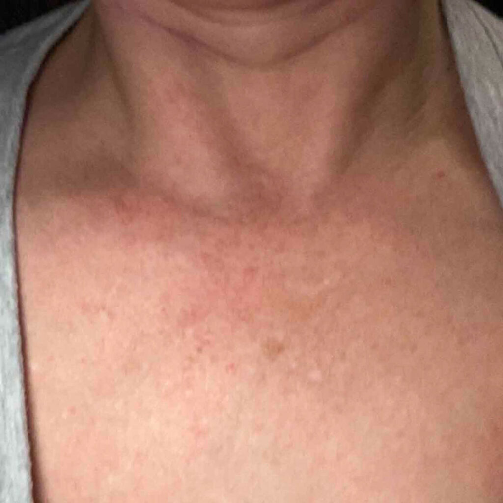 Primer plano del cuello y la parte superior del pecho de una persona, donde se aprecian rojeces y pequeñas manchas en la piel. La persona lleva una camisa de color claro.