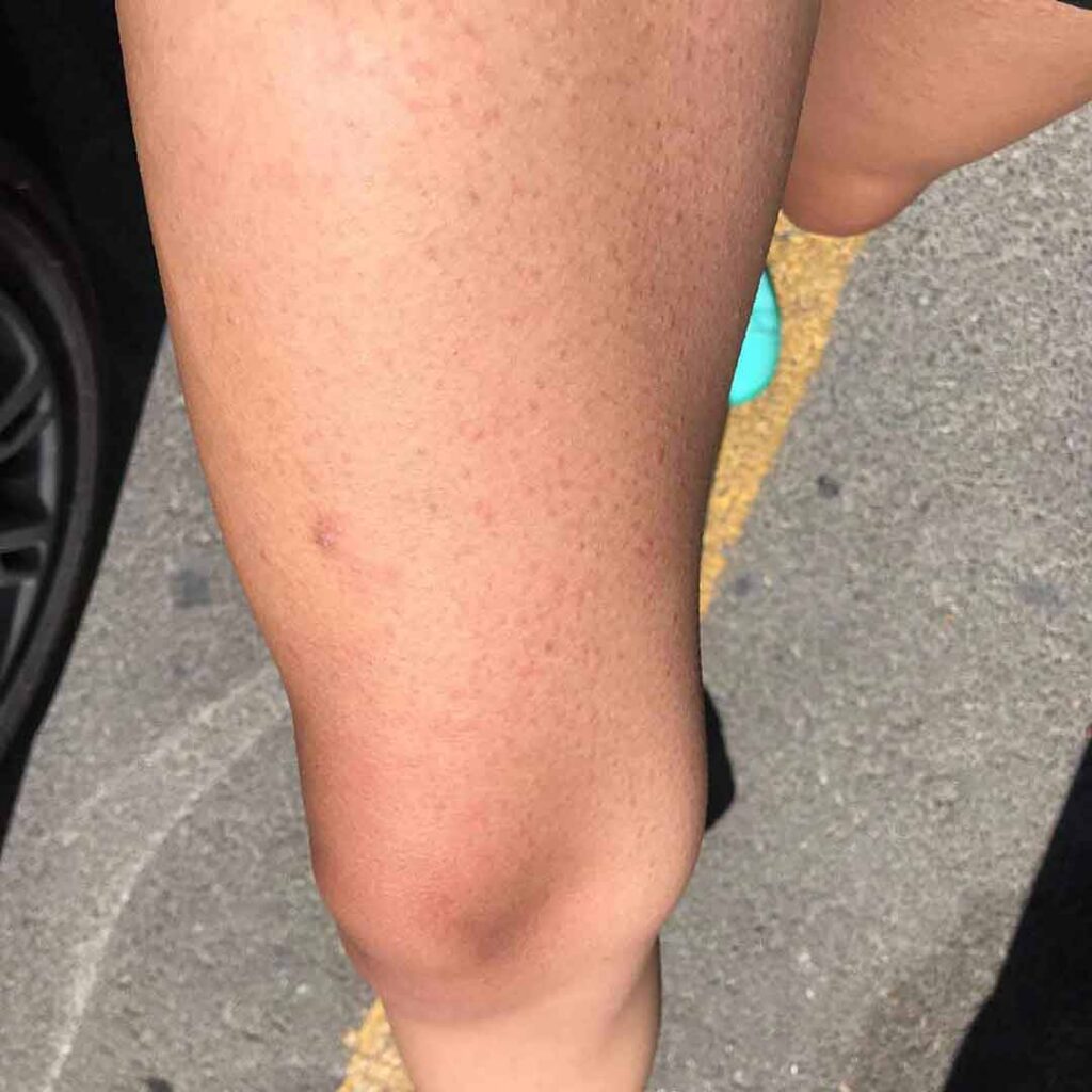 Primer plano de las piernas de una persona de pie sobre asfalto, donde se aprecia un pequeño hematoma o marca en la pierna izquierda. La persona lleva pantalones cortos y zapatos turquesa. Se ve parcialmente un neumático de coche a la izquierda.