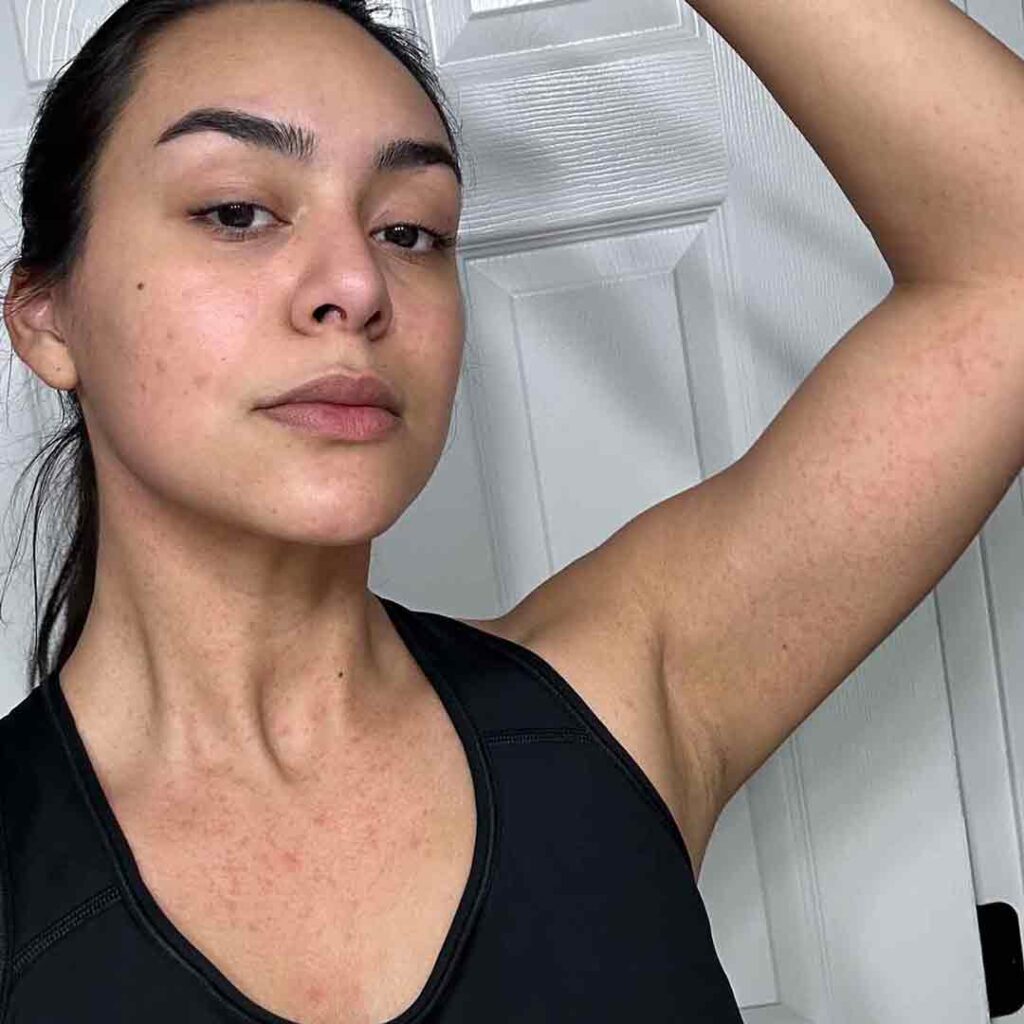 Una mujer con una camiseta negra de tirantes posa con el brazo levantado, mostrando zonas rojas e irritadas en el brazo y el pecho. Tiene una expresión neutra y está de pie frente a una puerta blanca.