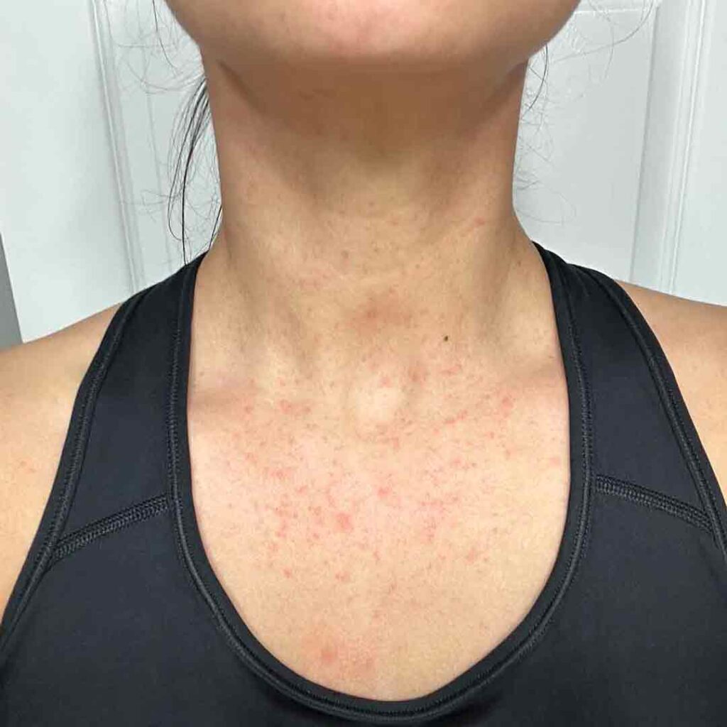 Una persona que lleva una camiseta de tirantes negra con una erupción o irritación roja y manchada visible en el cuello y la parte superior del pecho sobre un fondo blanco.