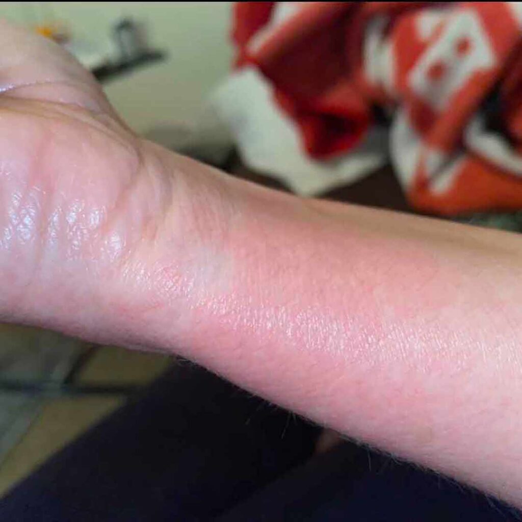 Primer plano del antebrazo interno de una persona, donde se aprecia piel enrojecida e irritada, posiblemente debido a una erupción o reacción alérgica. El fondo está ligeramente desenfocado, dejando ver una manta roja y blanca.