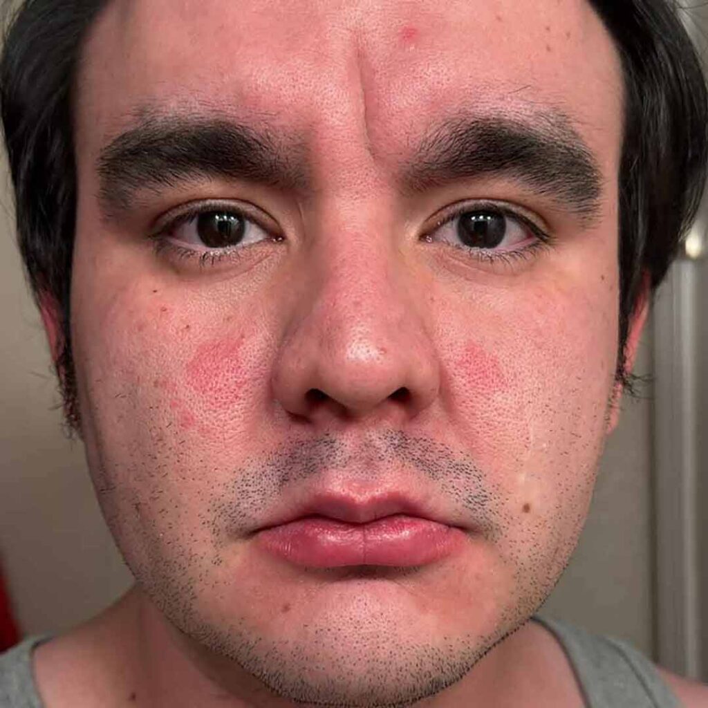 Primer plano de una persona con cabello corto y oscuro, y barba incipiente, que muestra zonas rojas e irritadas en las mejillas y la frente. La expresión es neutra y el fondo está desenfocado.