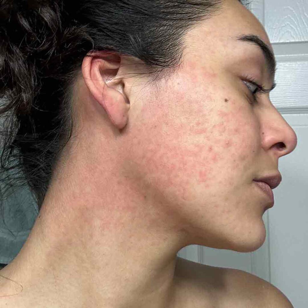 Una persona de cabello oscuro y hombros descubiertos muestra el lateral de su rostro y cuello, que aparecen enrojecidos e irritados con acné y manchas visibles, sobre un fondo de puerta blanca.