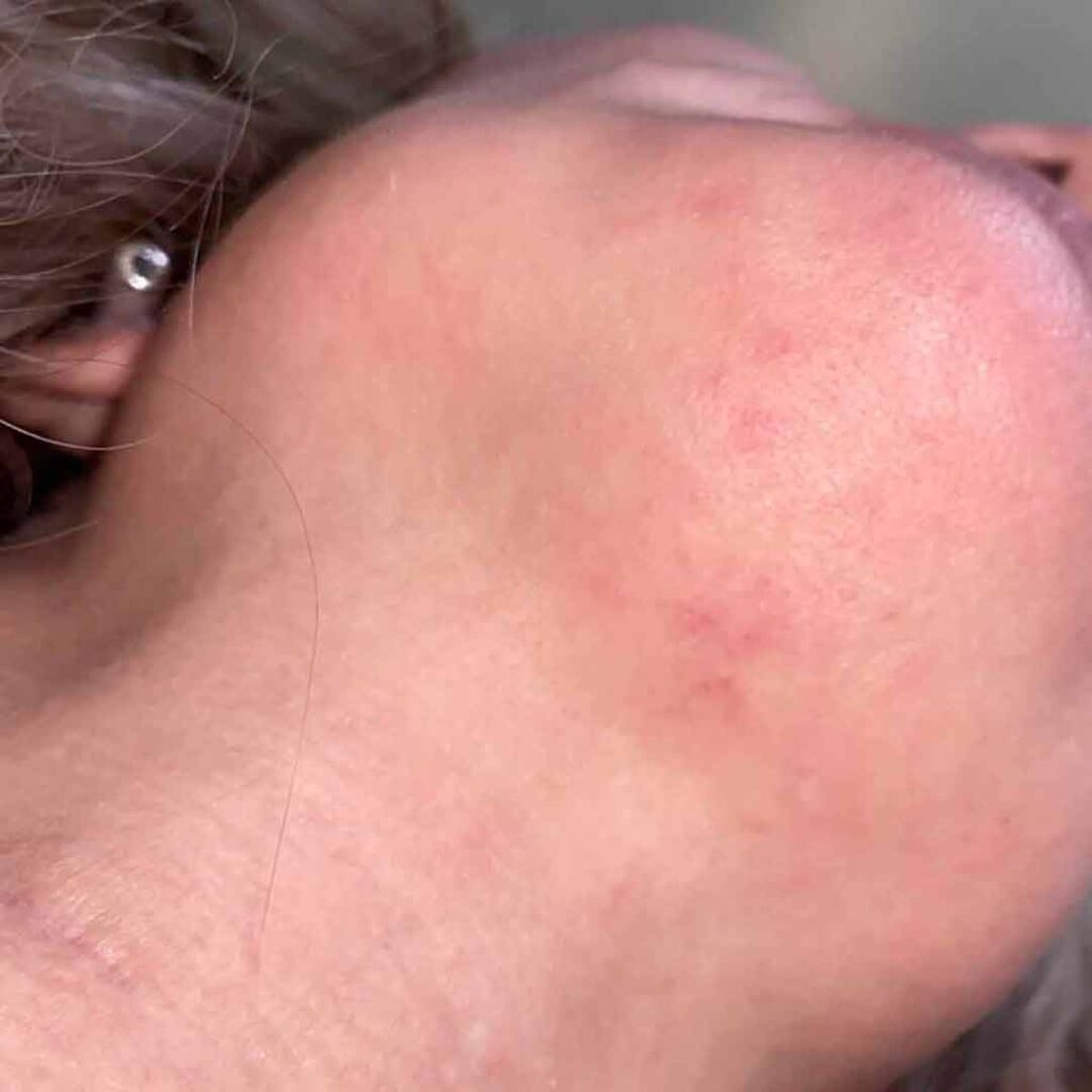 Primer plano del mentón y la mandíbula de una persona, con un ligero enrojecimiento y pequeñas imperfecciones en la piel, probablemente indicativas de irritación leve o acné. Se aprecia parte de la oreja y un piercing plateado.
