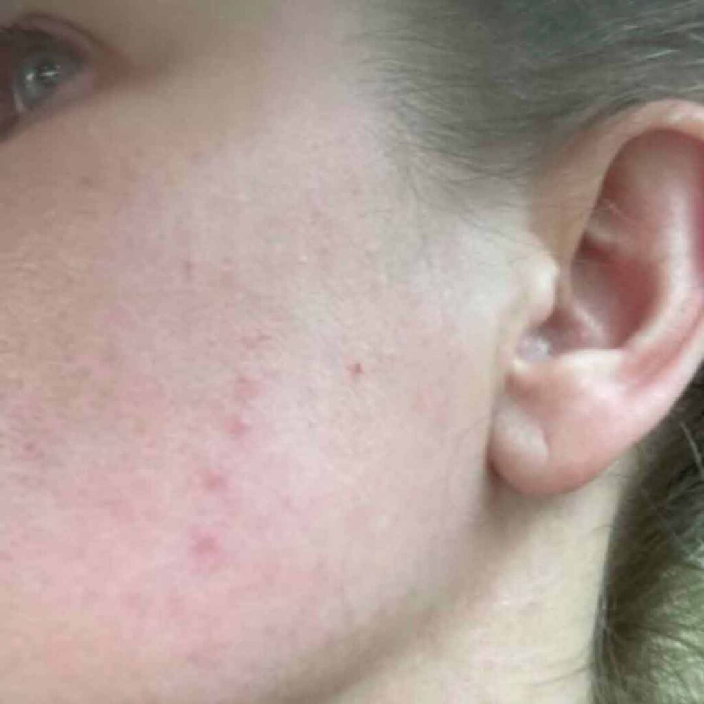 Primer plano de la mejilla y la oreja de una persona que muestra piel clara con algunas pequeñas manchas rojas de acné y un ligero enrojecimiento.