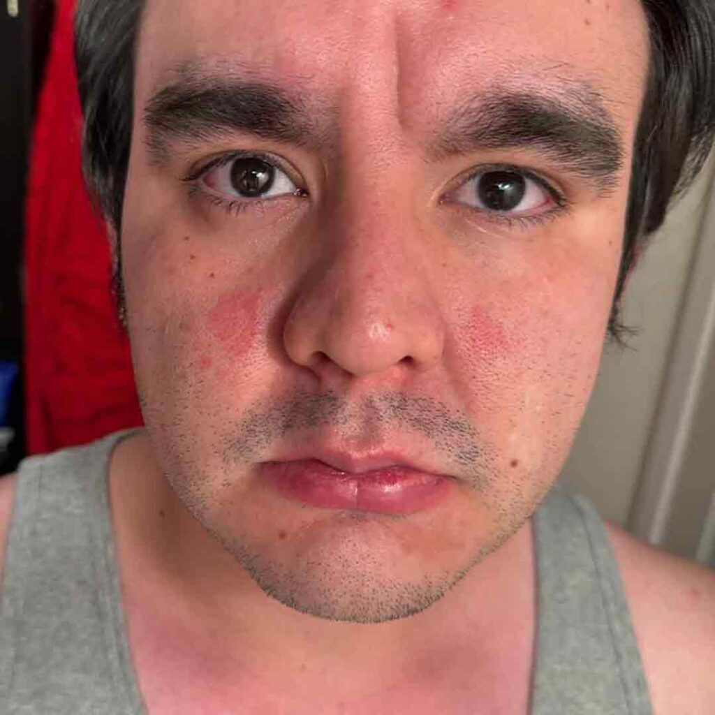 Un primer plano de una persona con cabello corto y oscuro y barba incipiente, que muestra manchas rojas e irritadas en ambas mejillas y varios granos pequeños en la frente. La persona lleva una camiseta sin mangas de color gris.