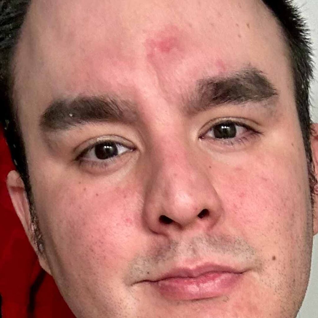 Primer plano de una persona con cabello corto y oscuro, cejas rectas y una leve marca roja en la frente, mirando directamente a la cámara con expresión neutra.