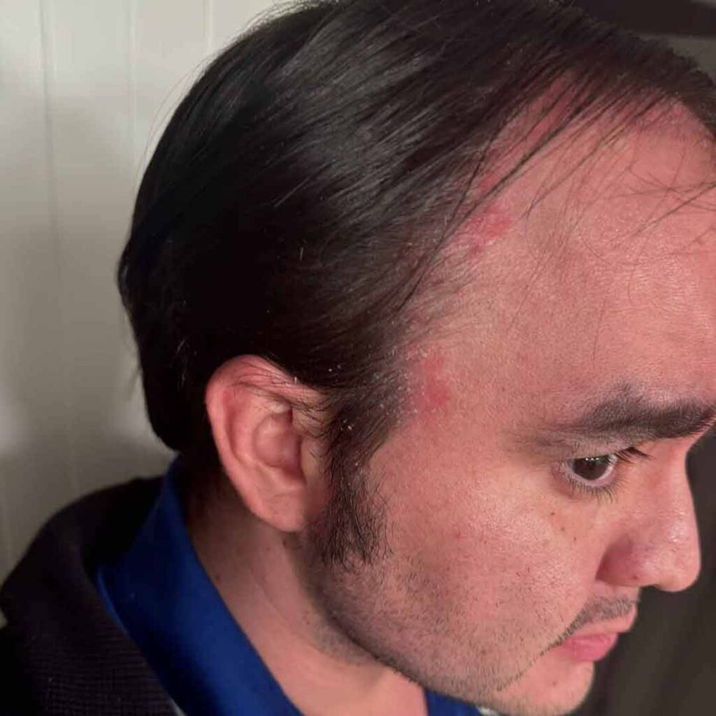 Un hombre con cabello ralo y entradas presenta protuberancias rojas visibles e irritación en el lateral de la frente y el cuero cabelludo, cerca de la línea del cabello.