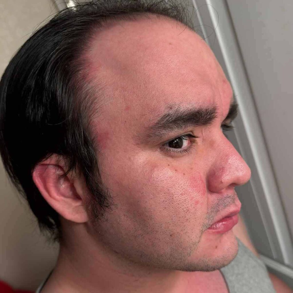 Un hombre con cabello ralo y enrojecimiento visible en la frente y la mejilla mira hacia un lado en un baño, vistiendo una camiseta sin mangas gris.
