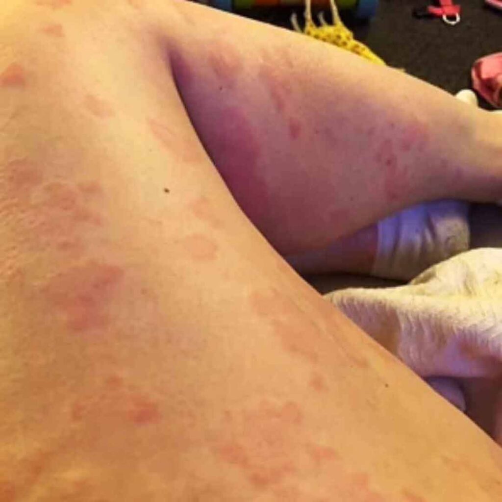 Primer plano de las piernas de una persona con numerosas manchas rojas y moteadas visibles en la piel. La persona está acostada, con una manta de color claro que cubre parcialmente un pie.