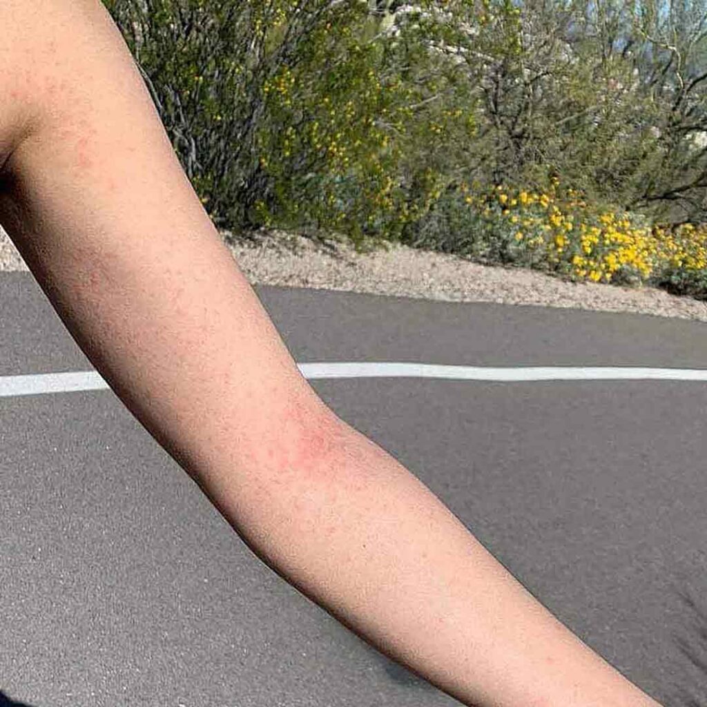 Primer plano del brazo desnudo de una persona con una leve erupción roja, al aire libre cerca de una carretera con arbustos verdes y flores amarillas al fondo.