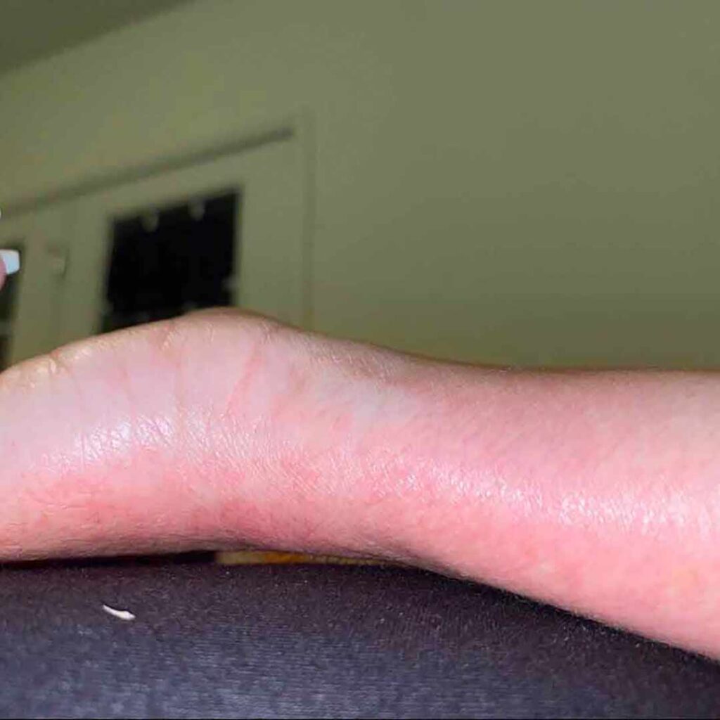 Primer plano de la mano y la muñeca de una persona apoyadas sobre una superficie; la muñeca parece hinchada o elevada. El fondo borroso muestra parte de una puerta y una pared.