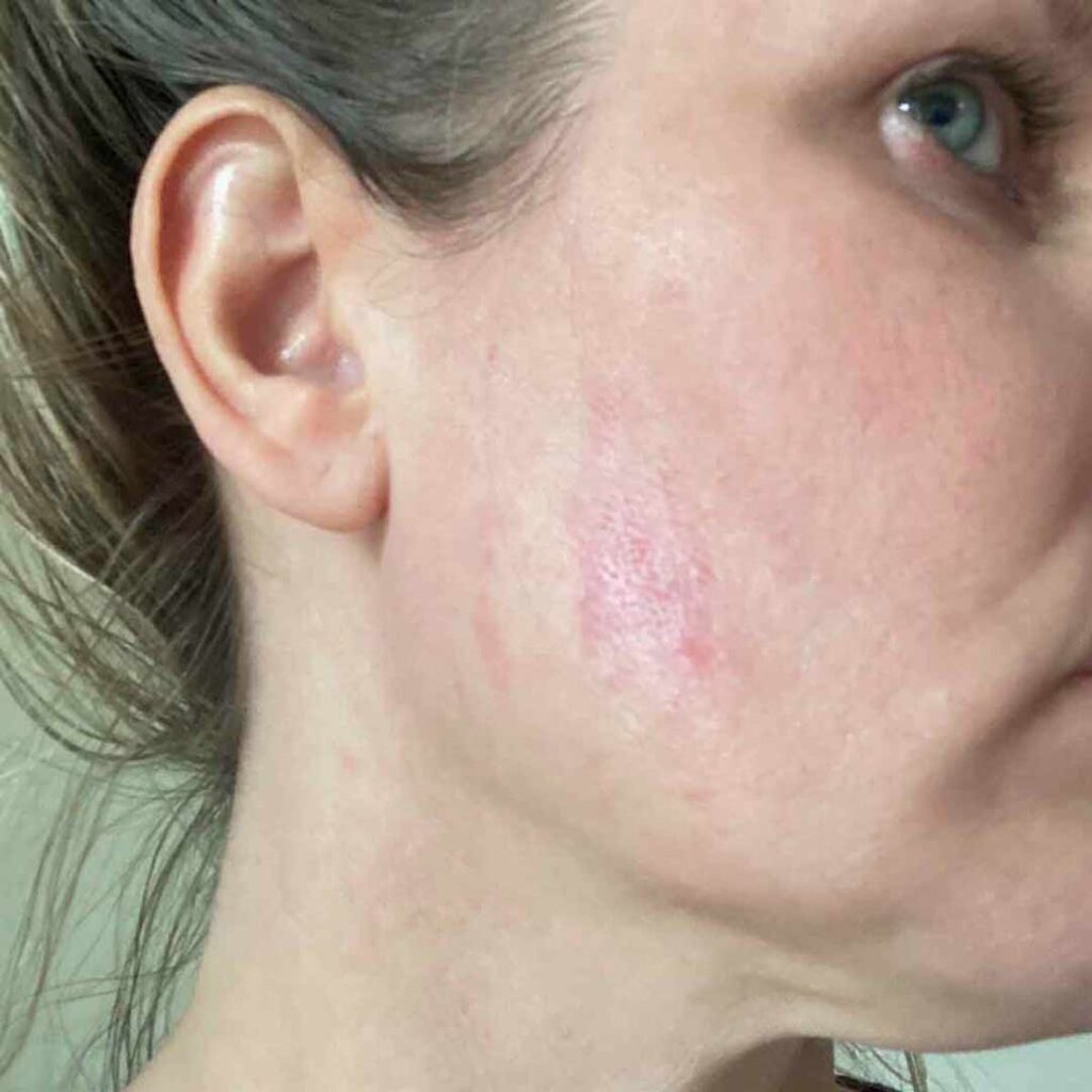 Primer plano del rostro de una mujer que muestra un leve enrojecimiento e irritación en la mejilla, cerca de la mandíbula. La piel aparece ligeramente inflamada con manchas rosadas visibles.