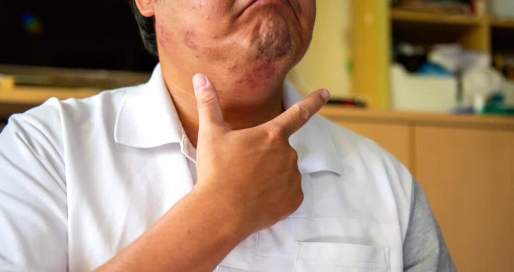 Una persona con camisa blanca señala su barbilla, donde se aprecian marcas y manchas de acné. Al fondo se ven estanterías y un televisor. Se distinguen parcialmente la boca y la nariz de la persona.