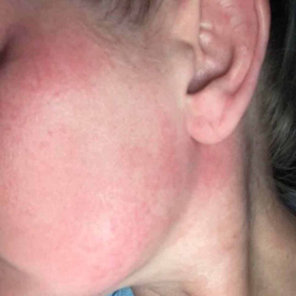 Primer plano del rostro y cuello de una persona que muestra piel enrojecida e irritada, con leve hinchazón, especialmente alrededor de la mejilla y la mandíbula. Se aprecia la oreja y el enrojecimiento se extiende hacia el cuello.
