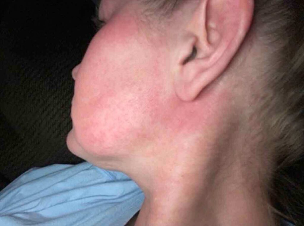 Una persona de tez clara, vista de perfil, presenta enrojecimiento notable e irritación leve en la mejilla y la mandíbula. Lleva una blusa azul claro y también se ven su oreja y cuello.