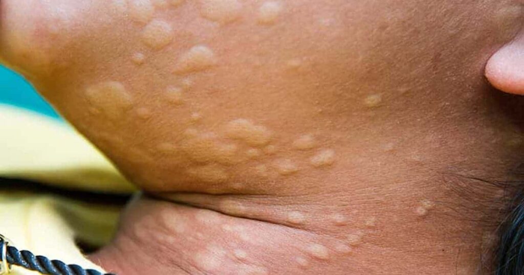 Primer plano del cuello y la barbilla de una persona que muestra múltiples protuberancias elevadas de color carne en la piel; urticaria.